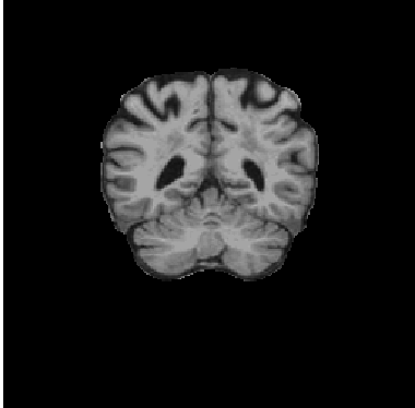 Post-Processed MRI using FreeSurfer