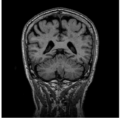 Raw MRI using MP-RAGE